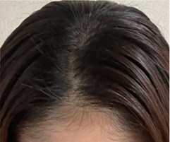 女性の治療事例2 治療後